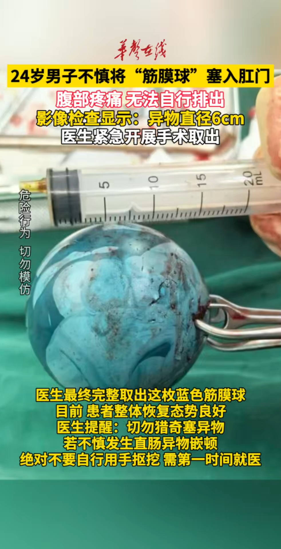 24岁男子不慎将筋膜球塞入肛门